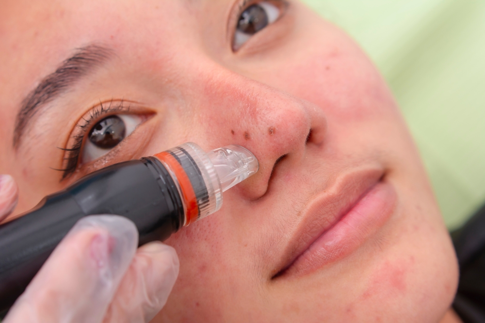 Where to Get Skin Peel Treatment in Gurgaon