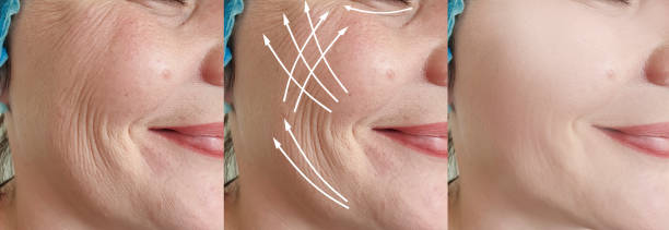 Remove Fine Lines and Wrinkles Treatment 2026 